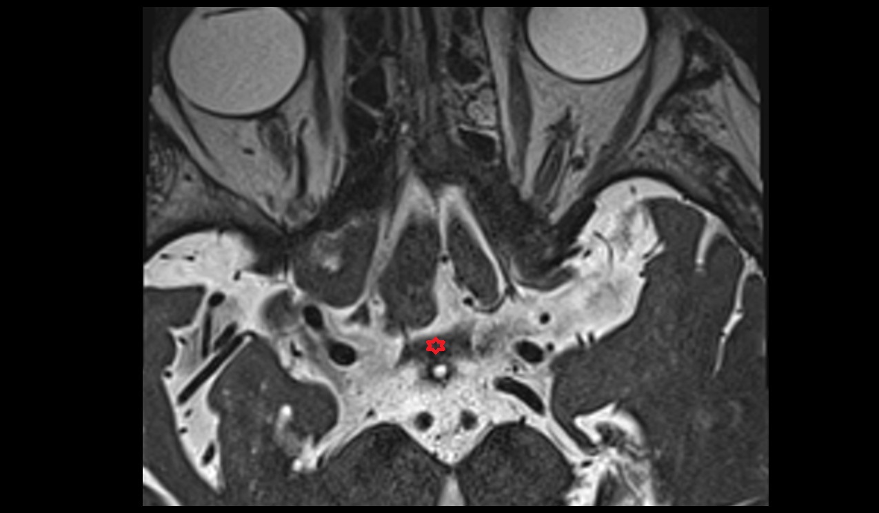 Optic chiasm MRI 3T axial image