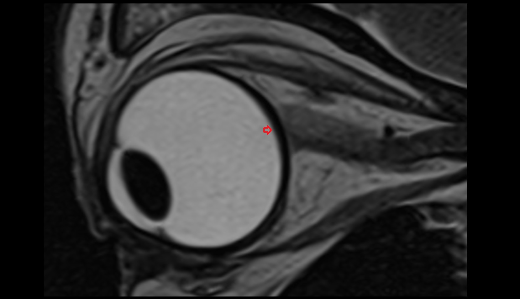 Optic disc mri image