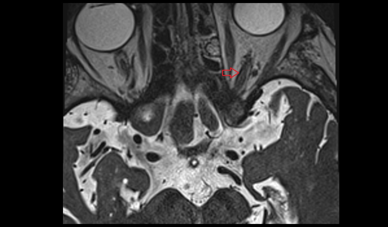 Optic nerve (Cranial nerve II) 3T MRI axial image