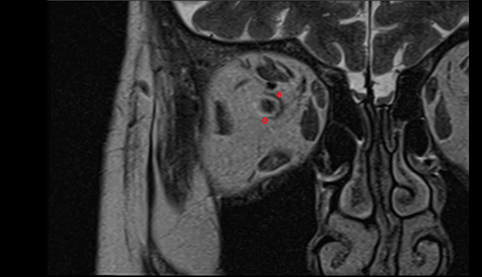 Optic nerve sheath mri image