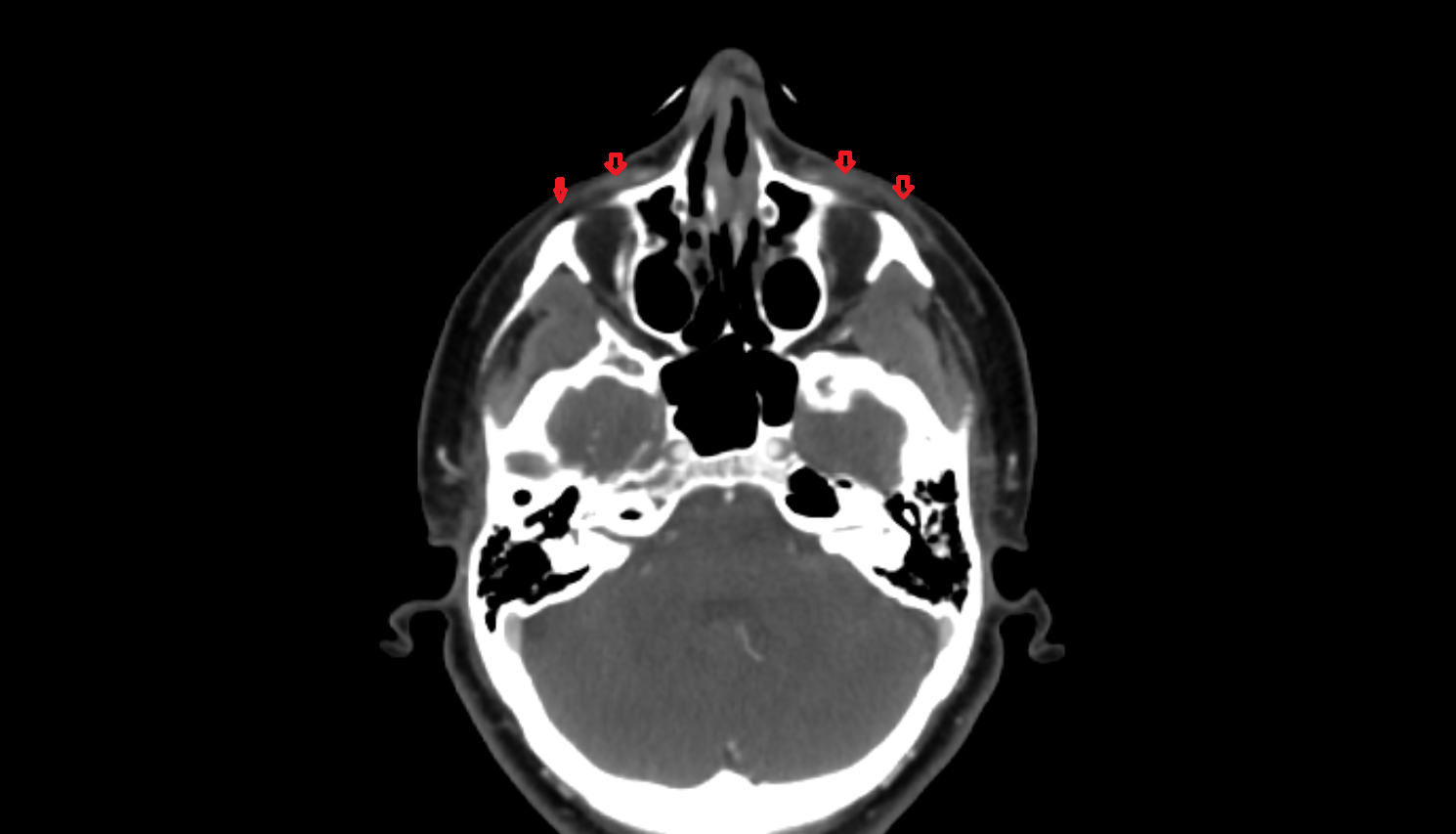 Orbicularis oculi muscle CT axial  image-img-00000-00000