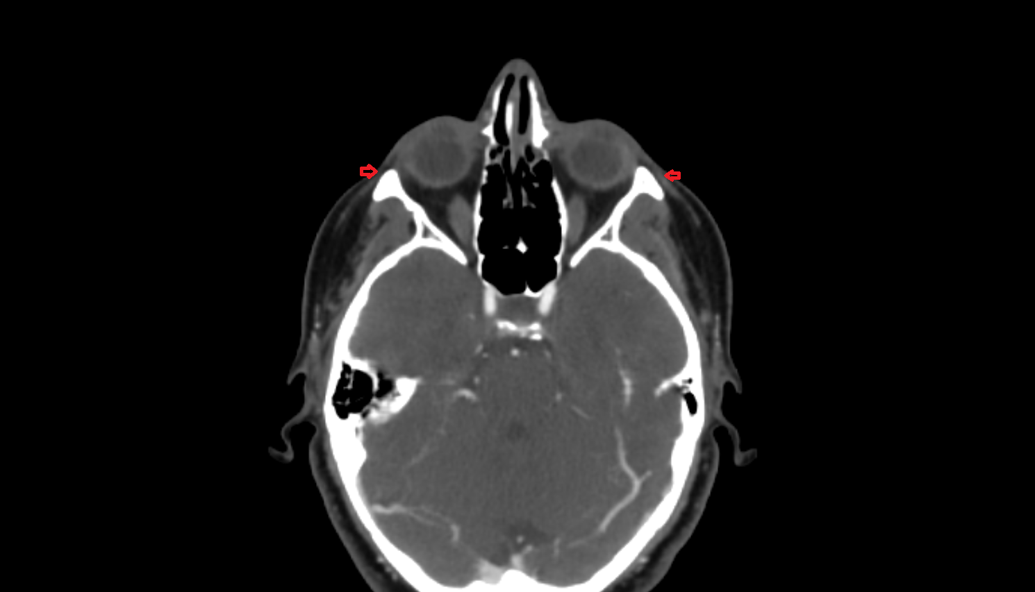 Orbicularis oculi muscle CT axial  image-img-00000-00000_00001
