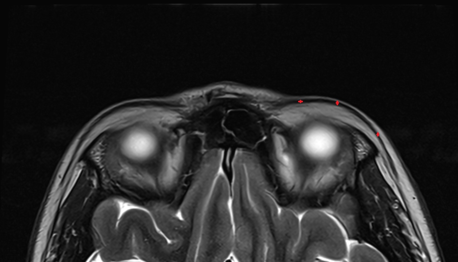 Orbicularis oculi muscle  (Orbital part)  mri axial image -img-00000-00000