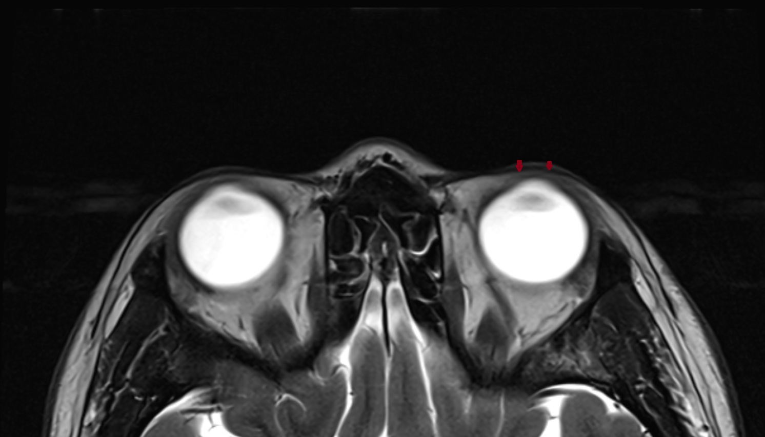 Orbicularis oculi muscle  (Preseptal part)  mri axial image 1 -img-00000-00000