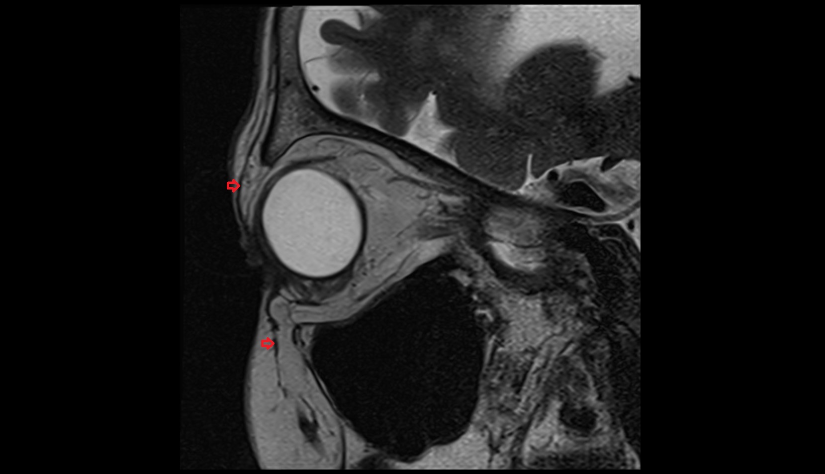 Orbicularis oculi muscle mri sagittal t2  image