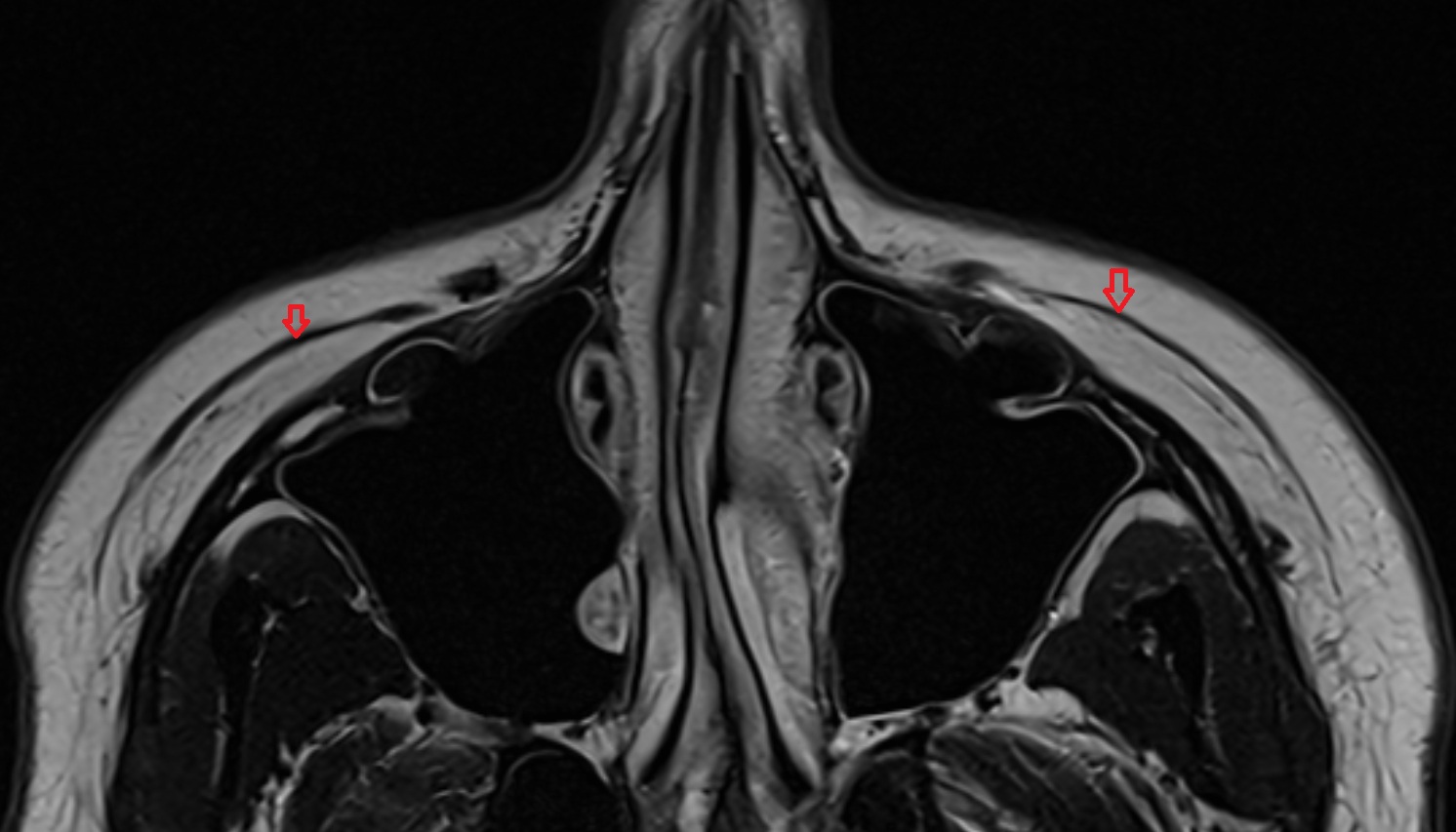 Orbital Part of Orbicularis Oculi Muscle axial image -img-00000-00000