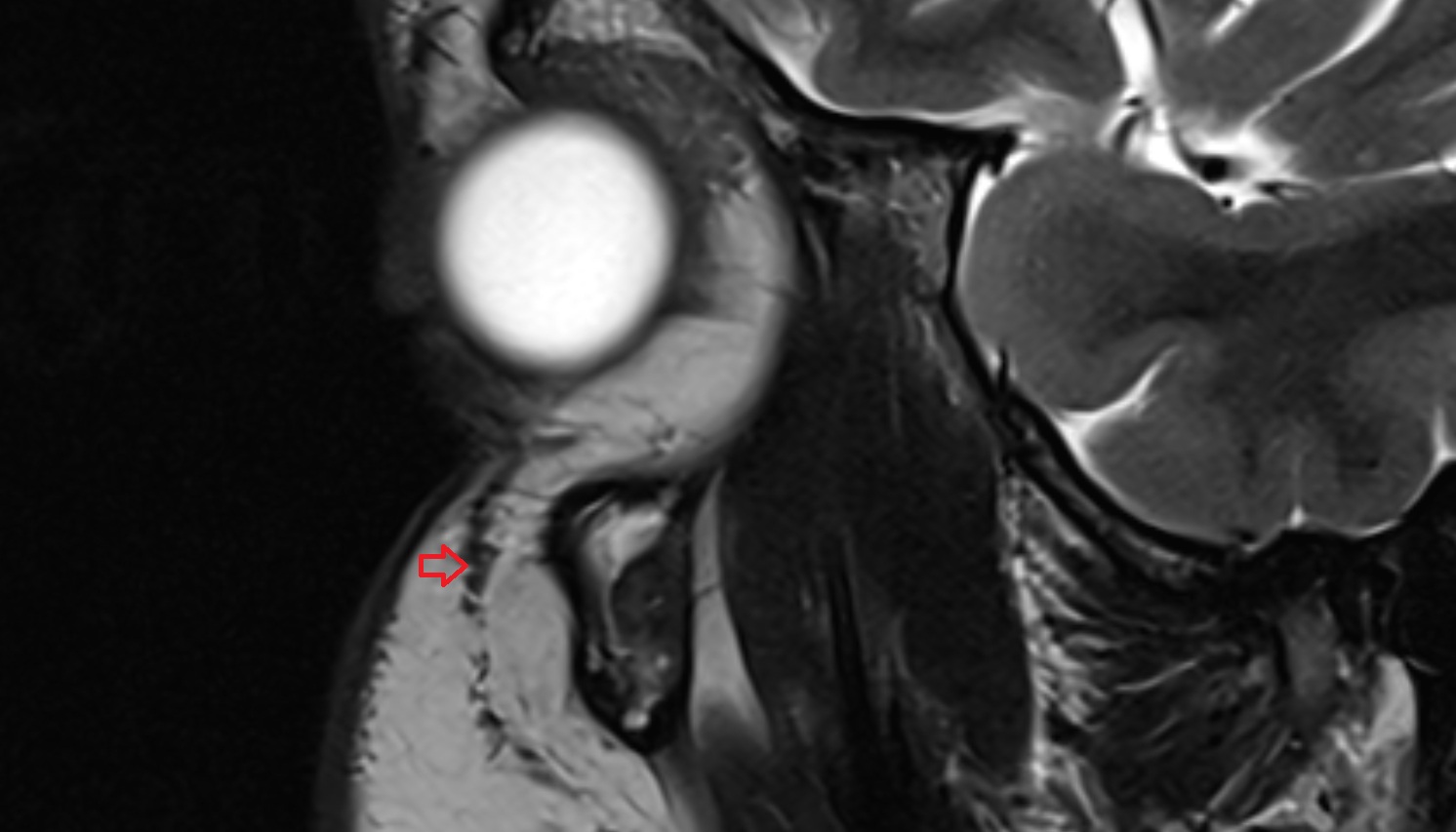Orbital Part of Orbicularis Oculi Muscle axial sag image -img-00000-00000