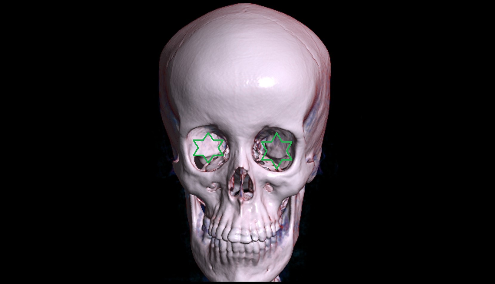 Orbital cavity 3d