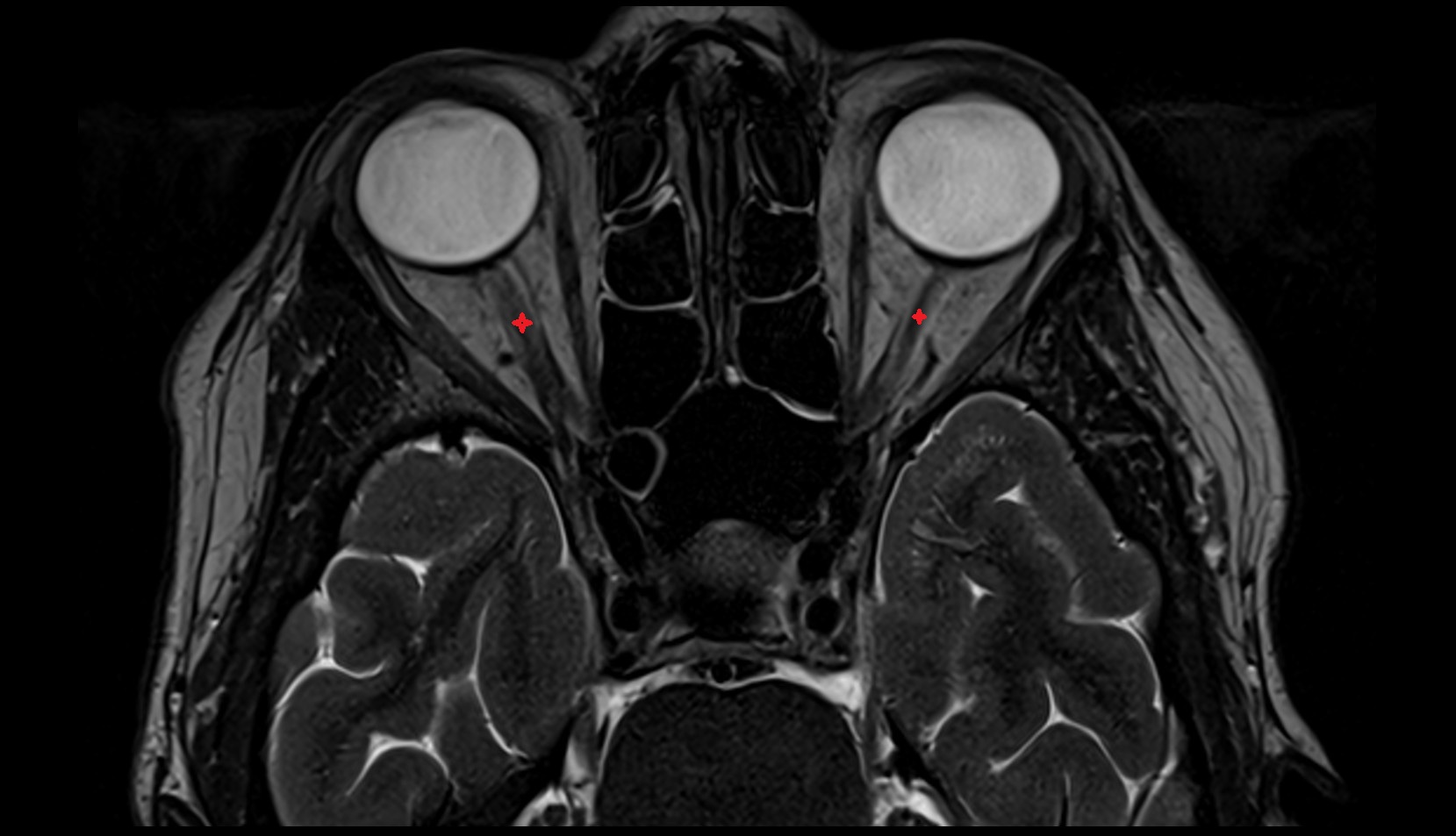 Orbital part of optic nerve