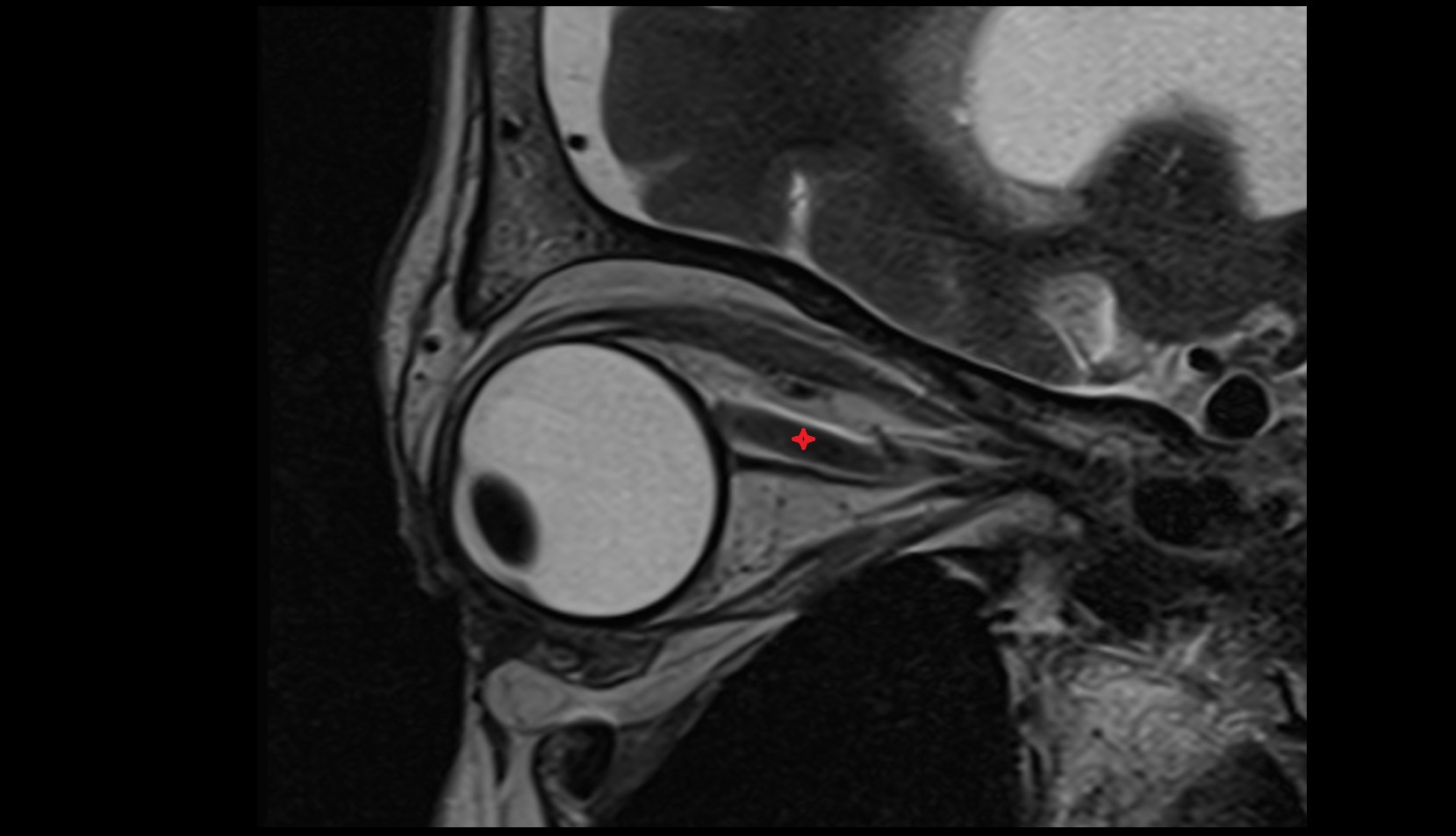 Orbital part of optic nerve mri image