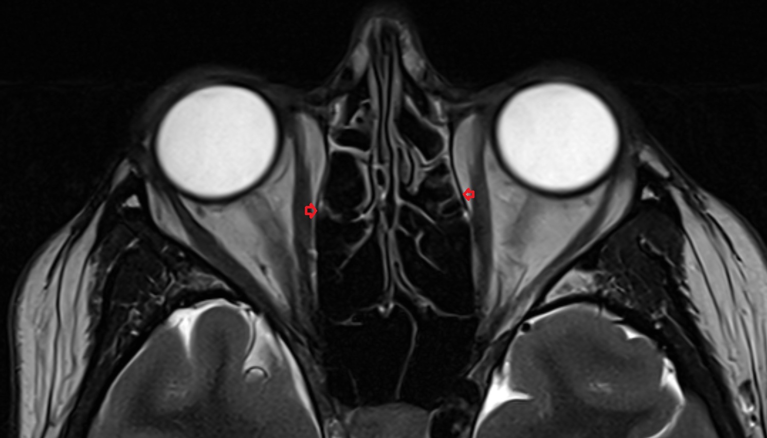 Orbital plate mri axial  image -img-00000-00000