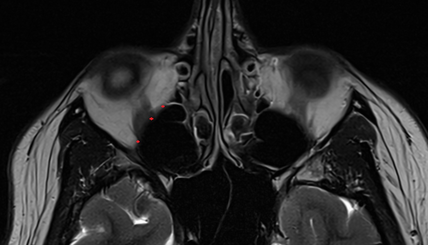 Orbital surface of maxilla  mri axial  image -img-00000-00000