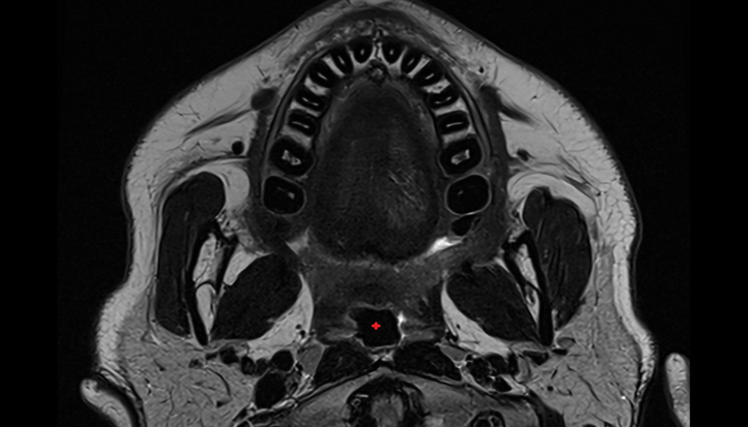 Oropharynx axial mri image -img-00000-00000