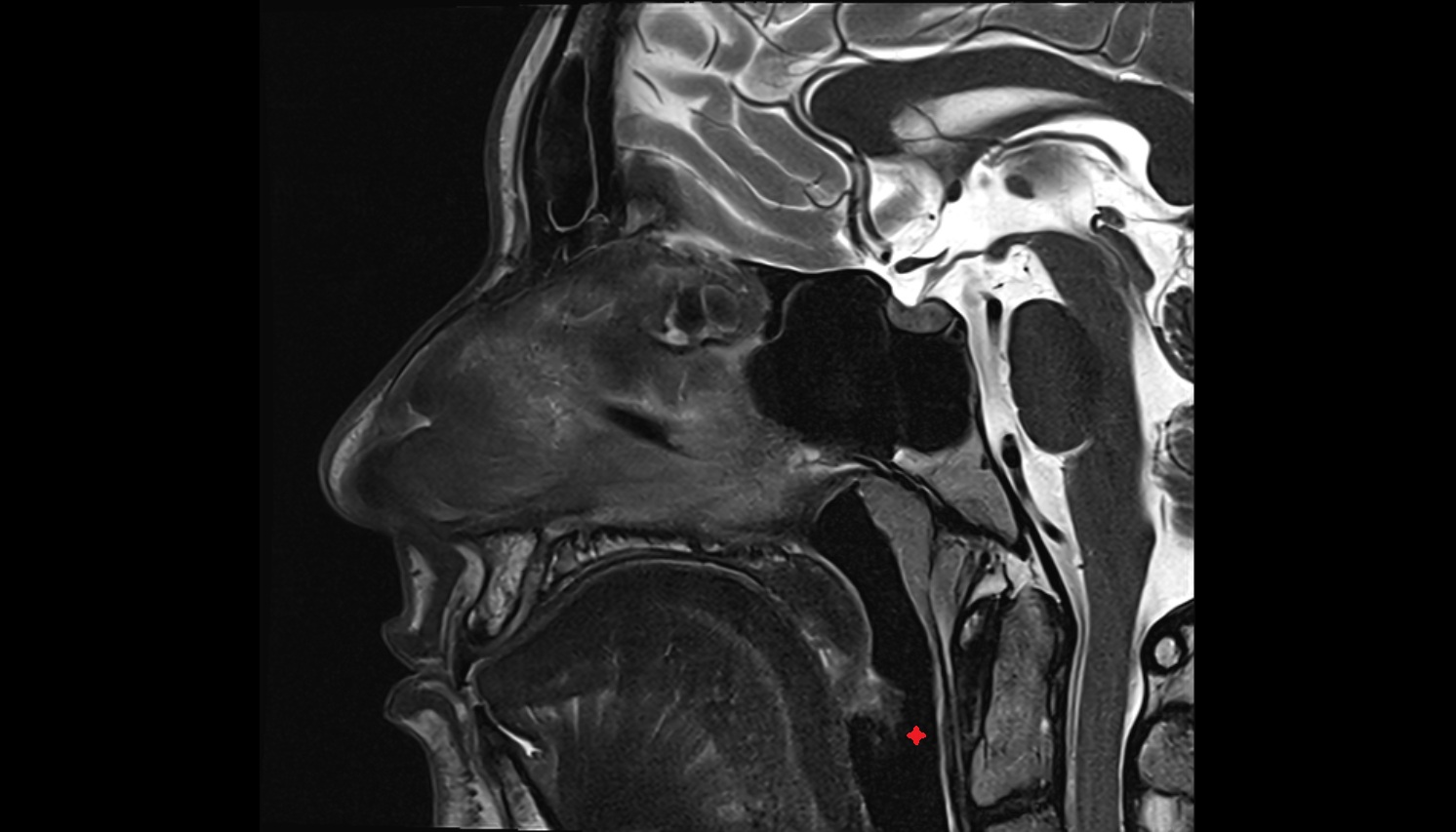 Oropharynx axial sag image -img-00000-00000