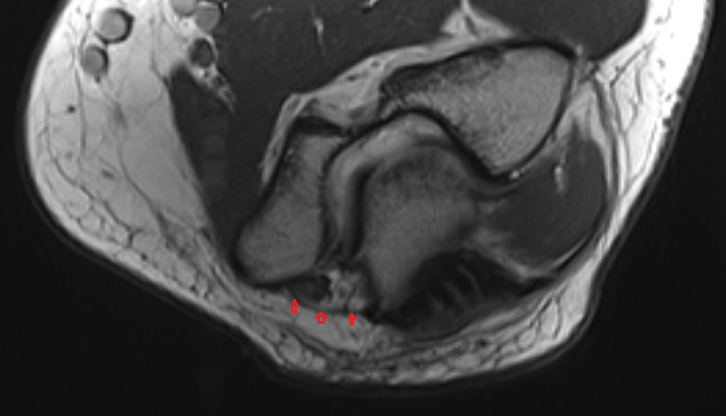 Osborne’s ligament (cubital tunnel retinaculum) of elbow  axial cross sectional anatomy 3T MRI AI enhanced radiology image -img-00000-00000