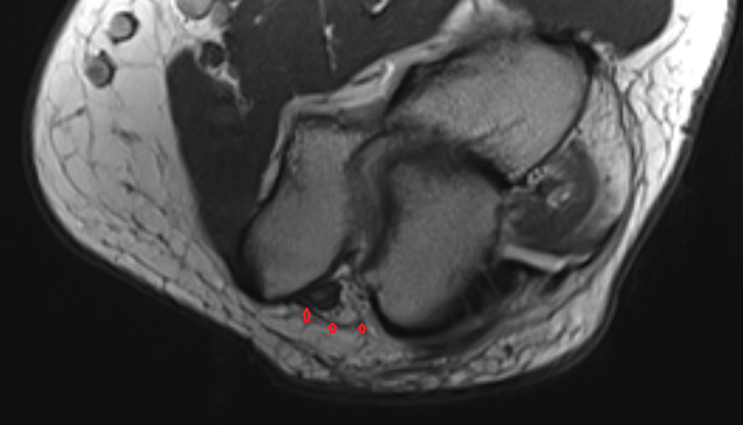 Osborne’s ligament (cubital tunnel retinaculum) of elbow  axial cross sectional anatomy 3T MRI AI enhanced radiology image -img-00000-00000_00001