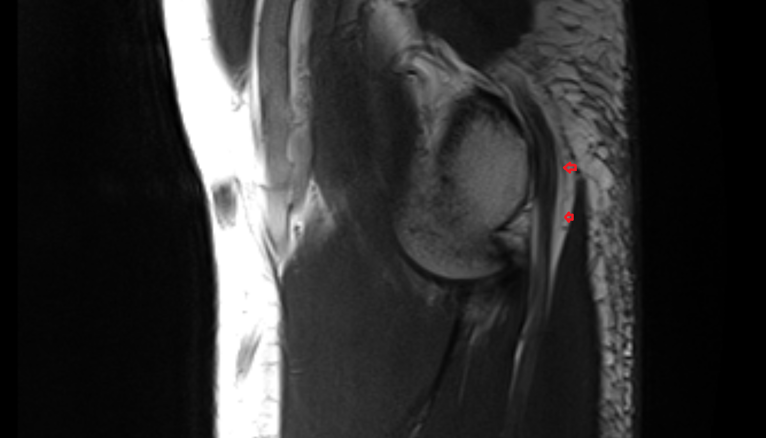 Osborne’s ligament (cubital tunnel retinaculum) of elbow  axial cross sectional anatomy 3T MRI AI enhanced radiology image -img-00000-00000_00002