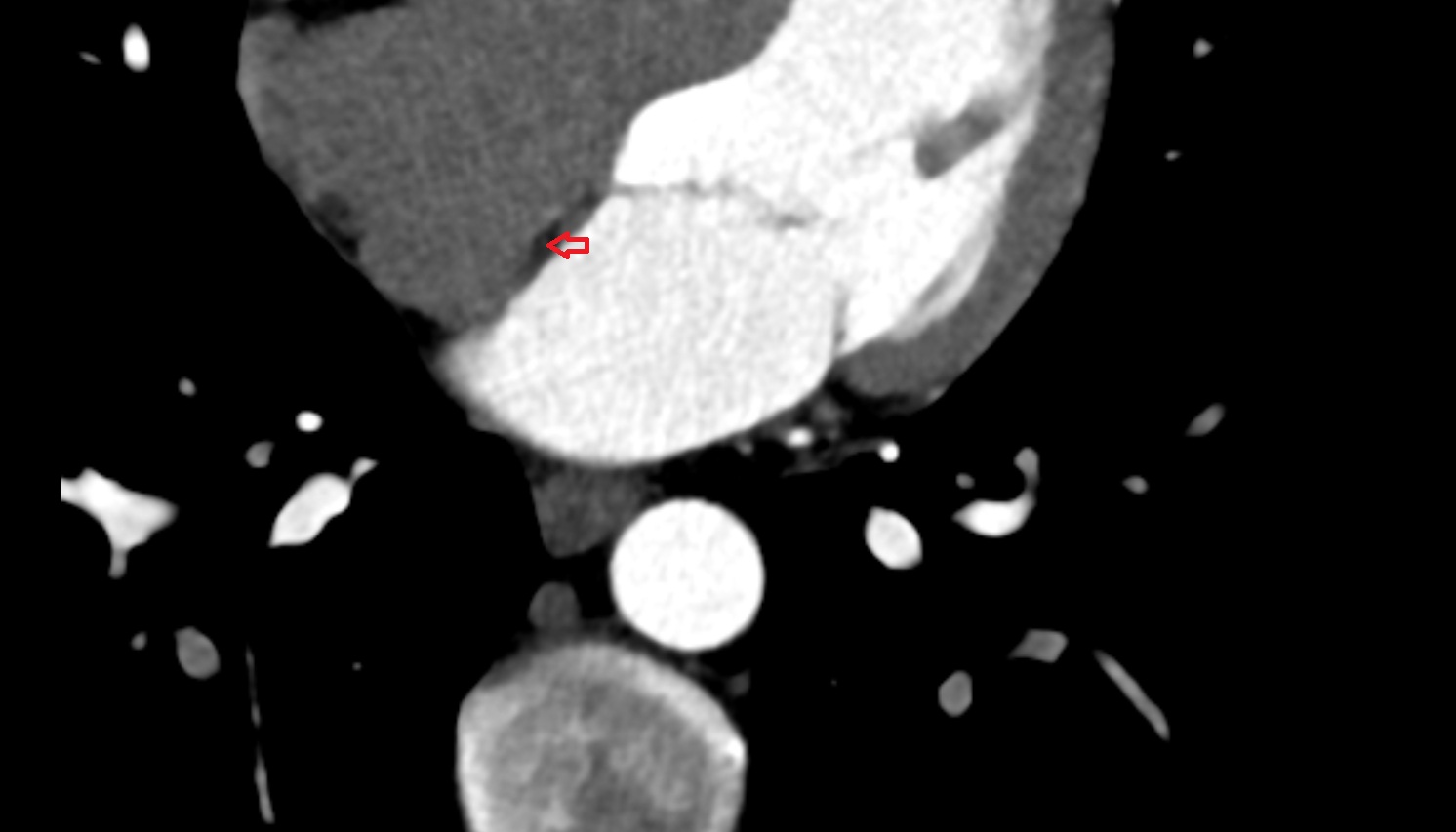 Oval fossa of right atrium  CT axial   image -img-00000-00000