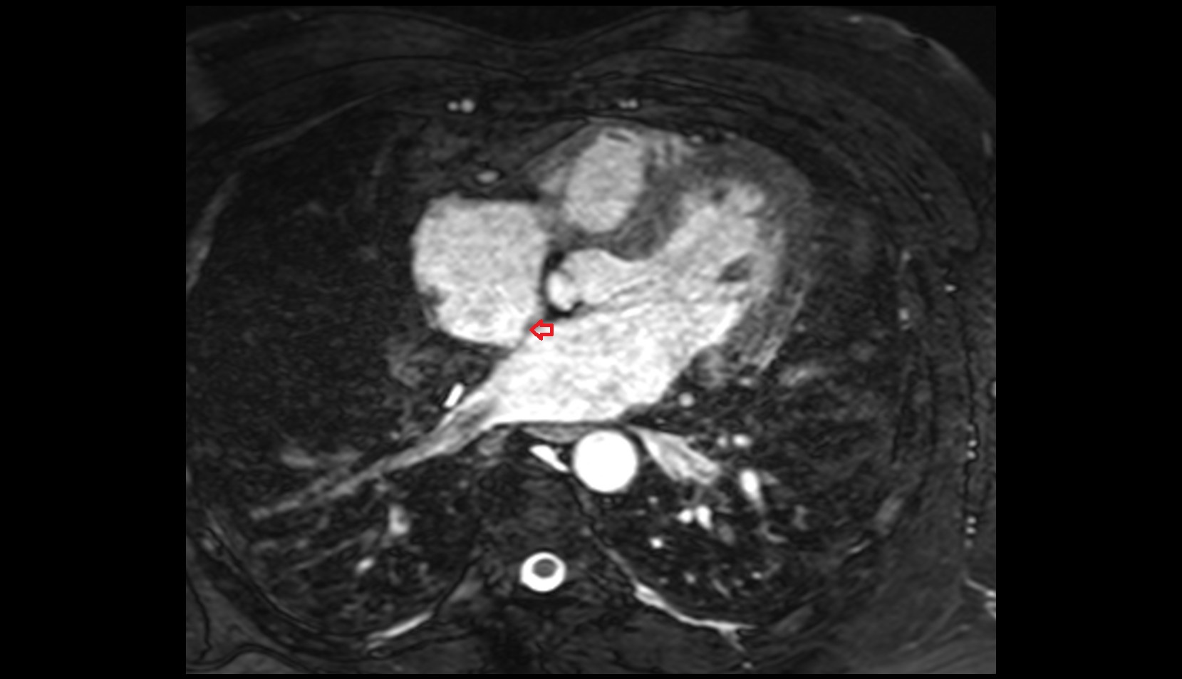 Oval fossa of right atrium mri image