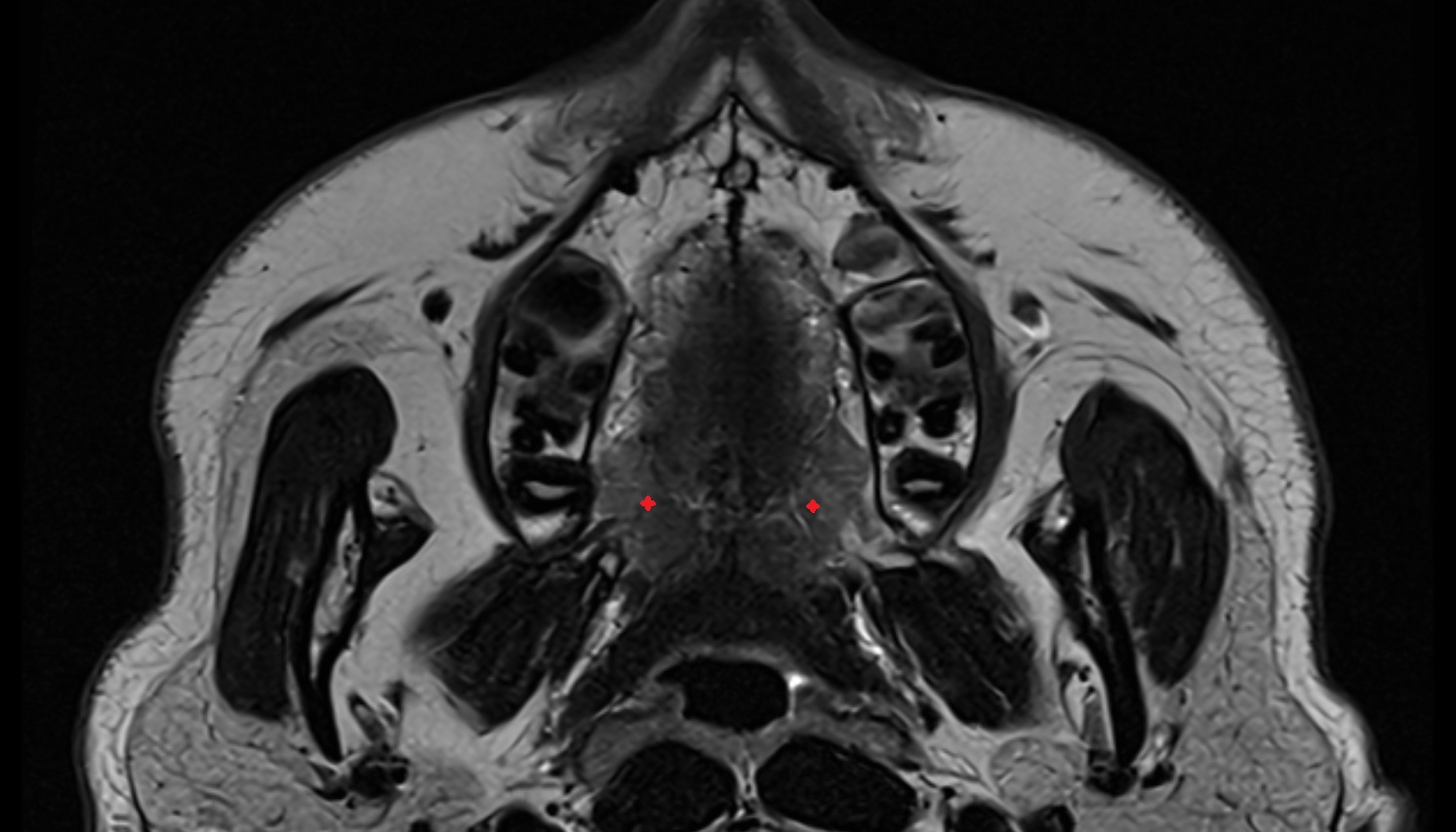 Palatine glands axial image -img-00000-00000_00001