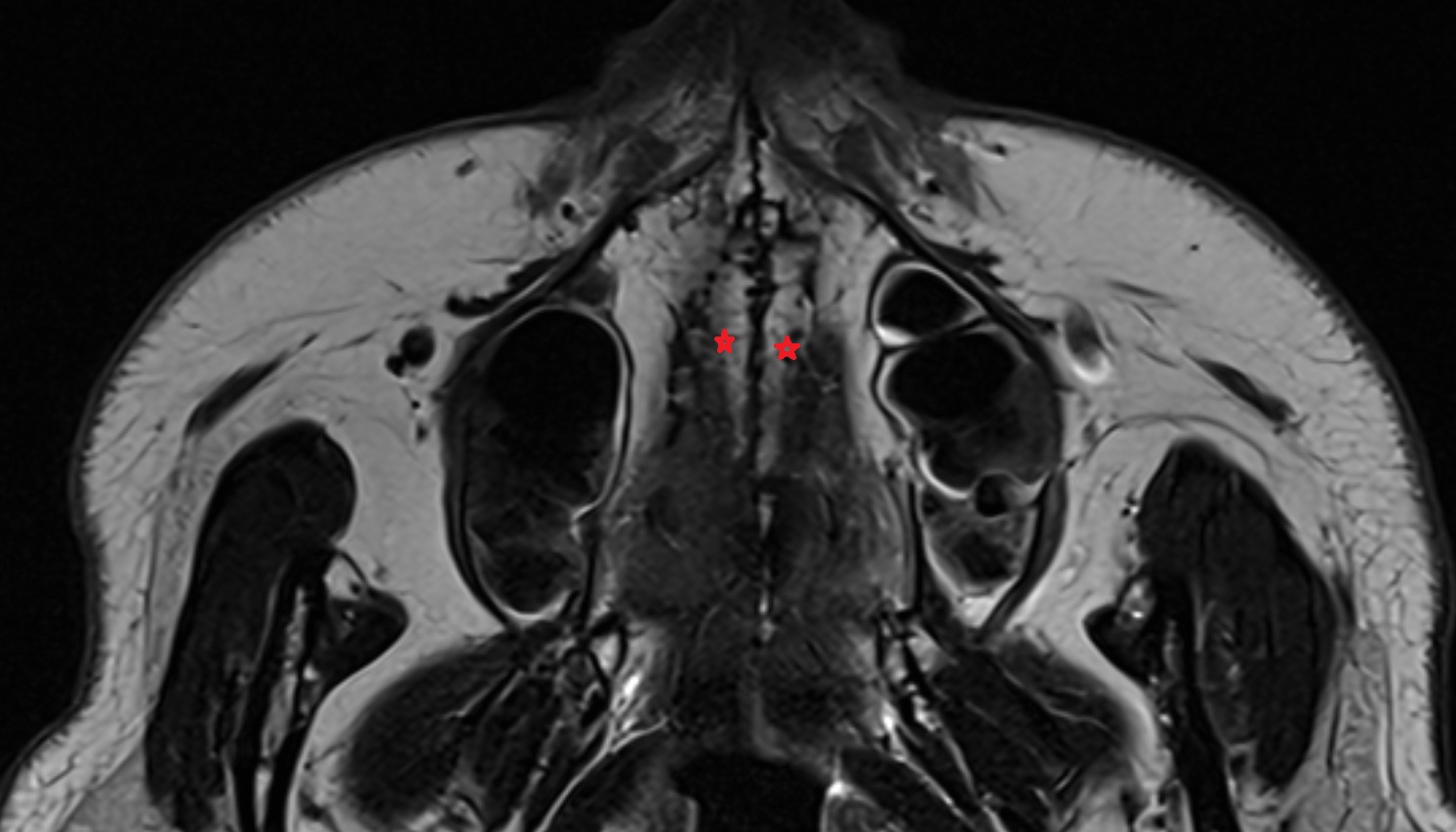Palatine process of maxilla  mri axial  image -img-00000-00000