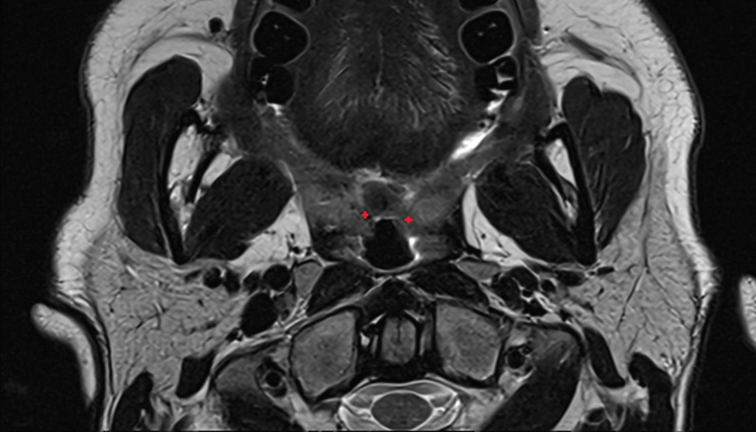 Palatopharyngeus muscle mri axial image 1 -img-00000-00000