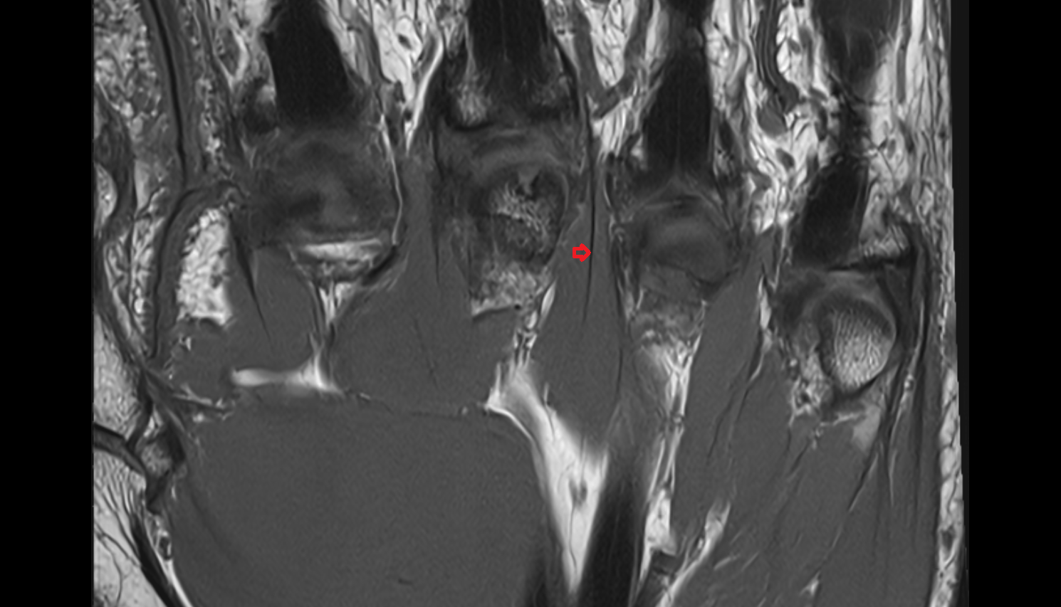 Palmar Interossei Tendon  hand  MRI axial  image-img-00000-00000