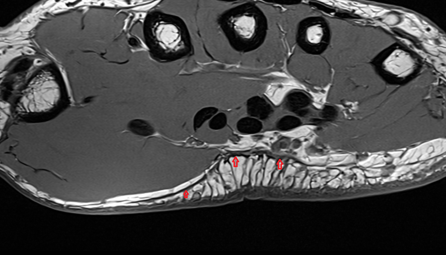 Palmar aponeurosis of wrist  axial cross sectional anatomy 3T MRI AI enhanced radiology image-img-00000-00000