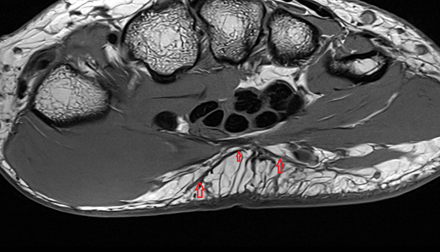Palmar aponeurosis of wrist  axial cross sectional anatomy 3T MRI AI enhanced radiology image-img-00000-00000_00001