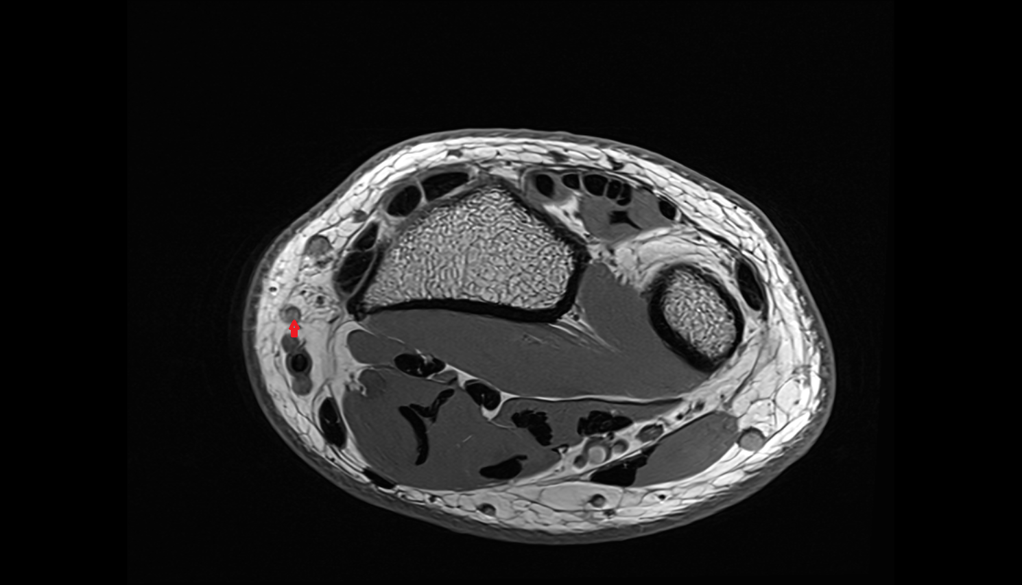 Palmar branch of cephalic vein  axial cross sectional anatomy 3T MRI AI enhanced radiology image-img-00000-00000