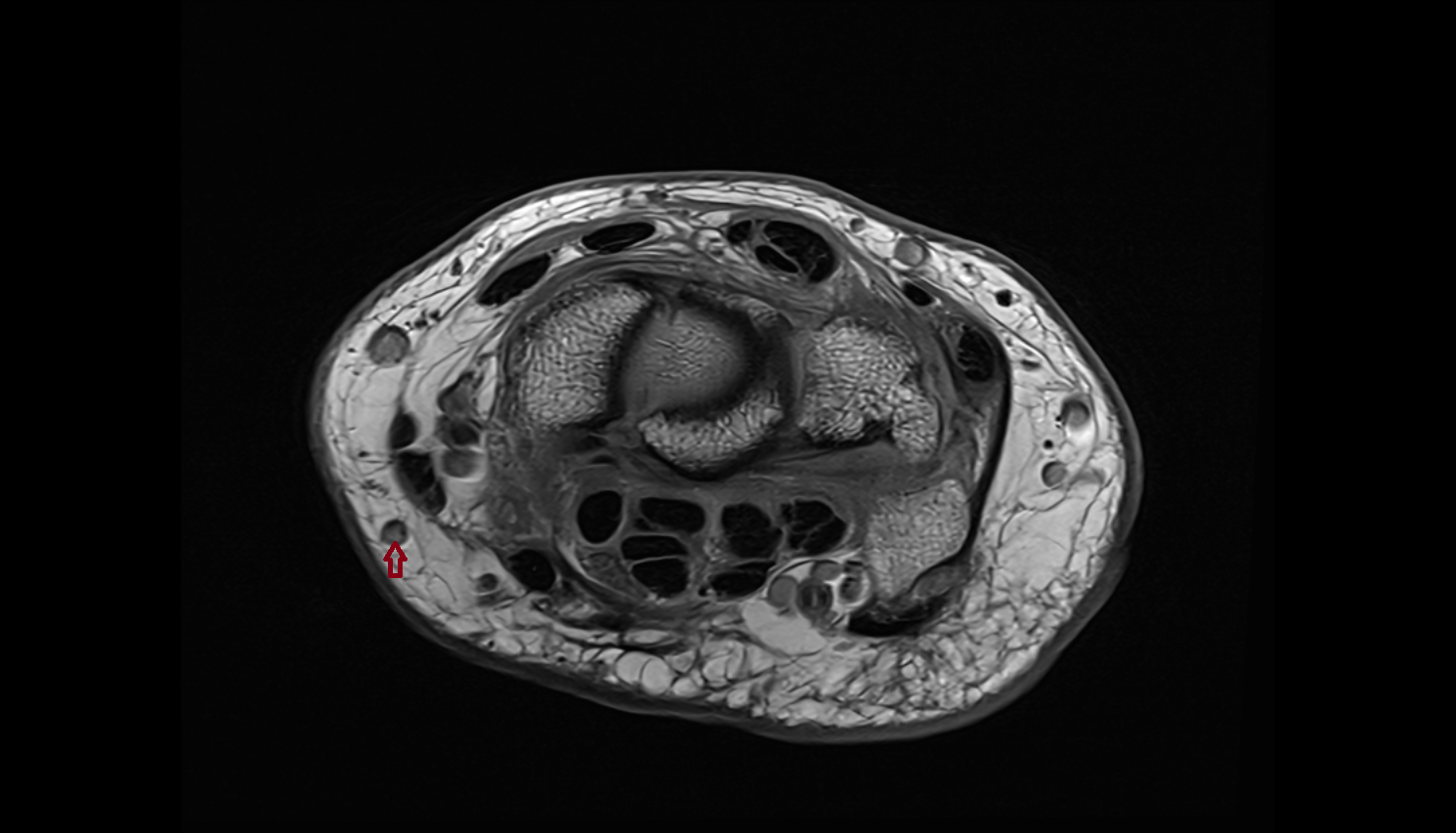 Palmar branch of cephalic vein  axial cross sectional anatomy 3T MRI AI enhanced radiology image-img-00000-00000_00001