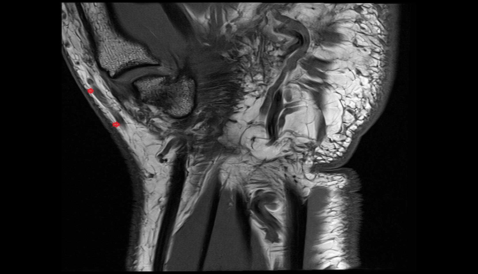 Palmar branch of cephalic vein coronal