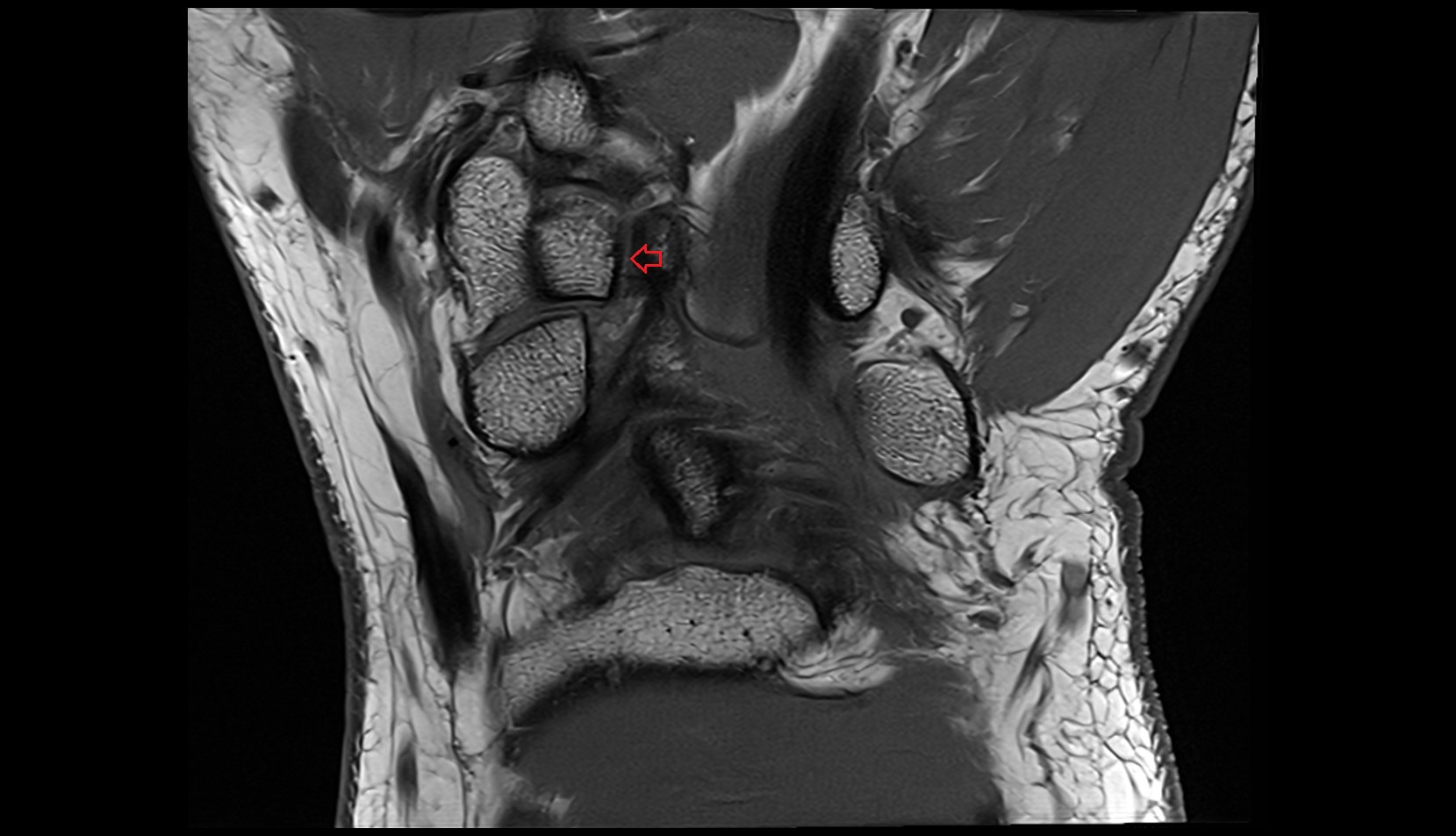 Palmar capitotrapezoid ligament (Trapezocapitate ligament) coronal mri image