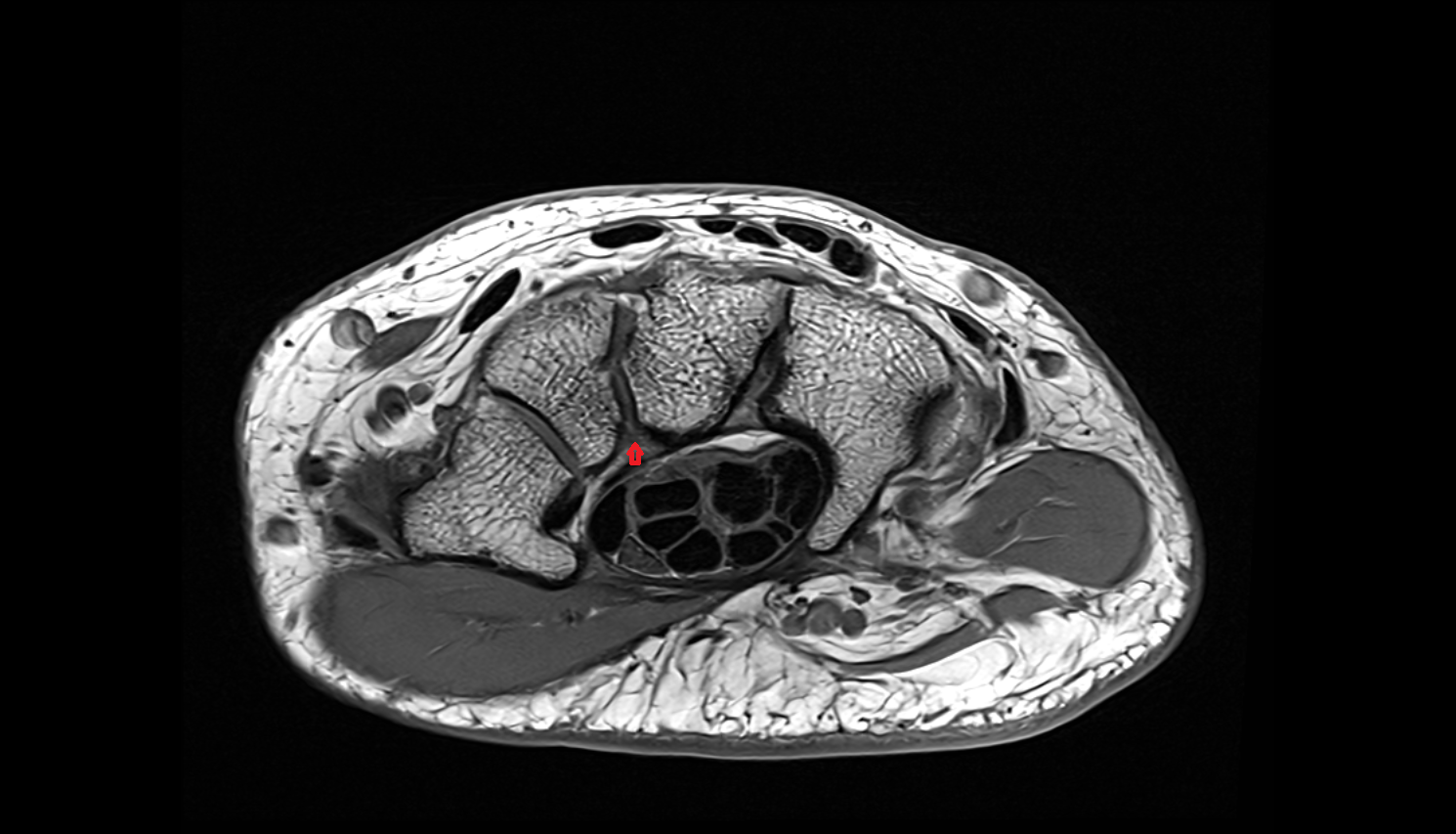 Palmar capitotrapezoid ligament (Trapezocapitate ligament)  mri axiall cross sectional anatomy 3T MRI AI enhanced radiology image-img-00000-00000