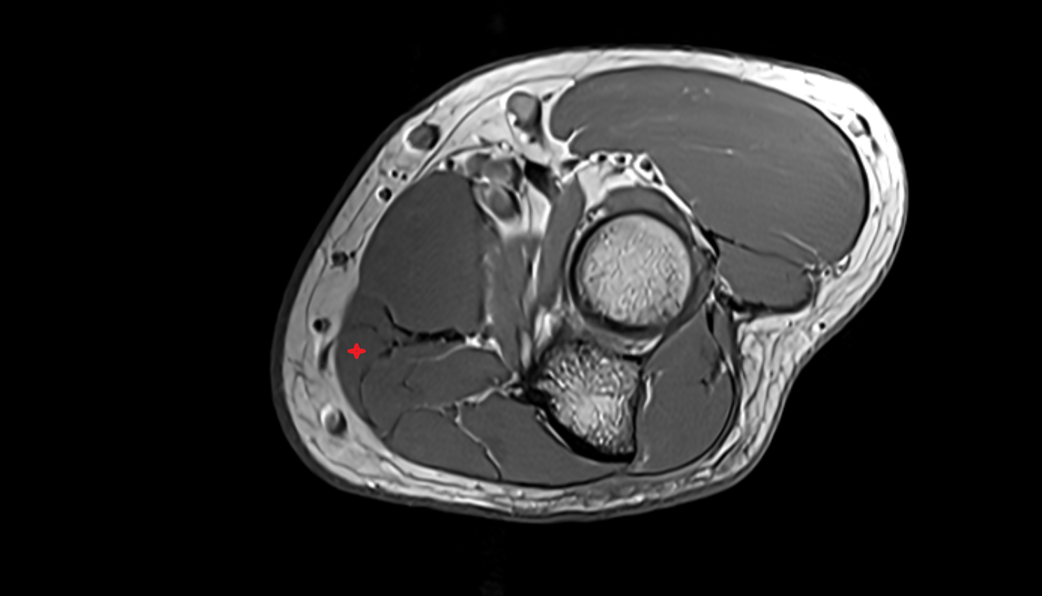 Palmaris longus muscle axial cross sectional anatomy 3T MRI AI enhanced radiology image -img-00000-00000