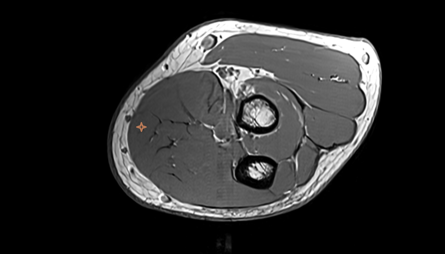 Palmaris longus muscle axial cross sectional anatomy 3T MRI AI enhanced radiology image -img-00000-00000_00001