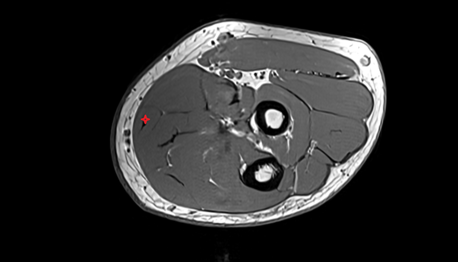 Palmaris longus muscle axial cross sectional anatomy 3T MRI AI enhanced radiology image -img-00000-00000_00002