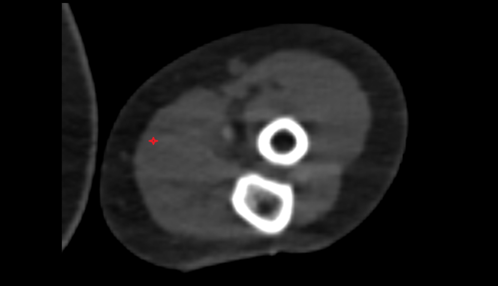 Palmaris longus muscle ct axial image