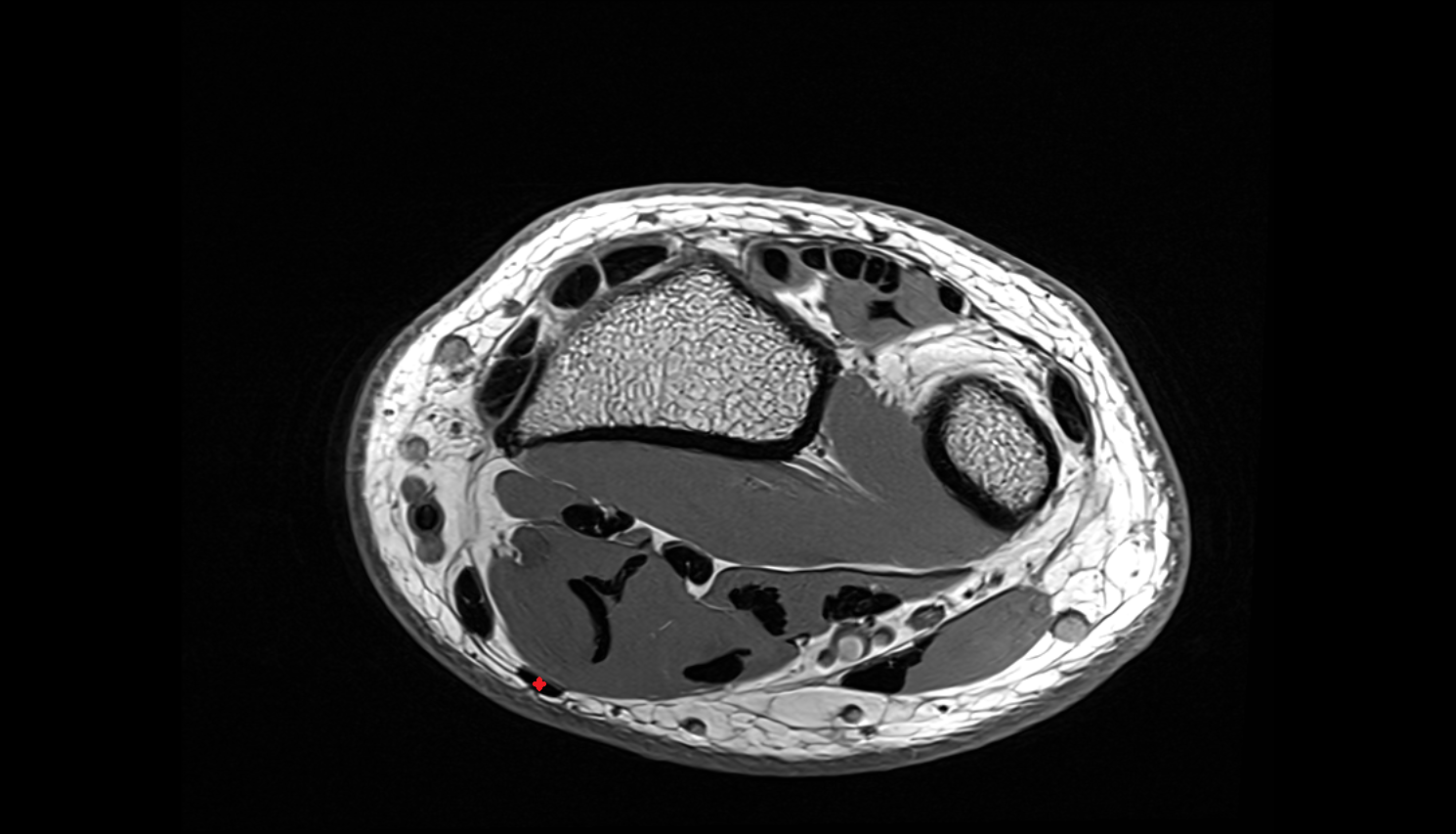 Palmaris longus tendon axial cross sectional anatomy 3T MRI AI enhanced radiology image-img-00000-00000