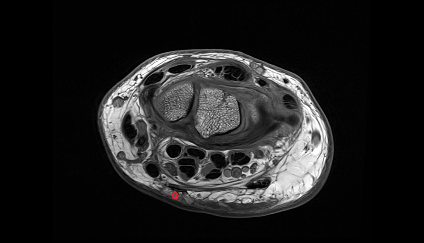 Palmaris longus tendon axial cross sectional anatomy 3T MRI AI enhanced radiology image-img-00000-00000_00001