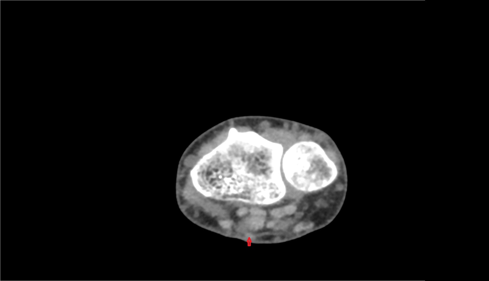 Palmaris longus tendon ct axial image