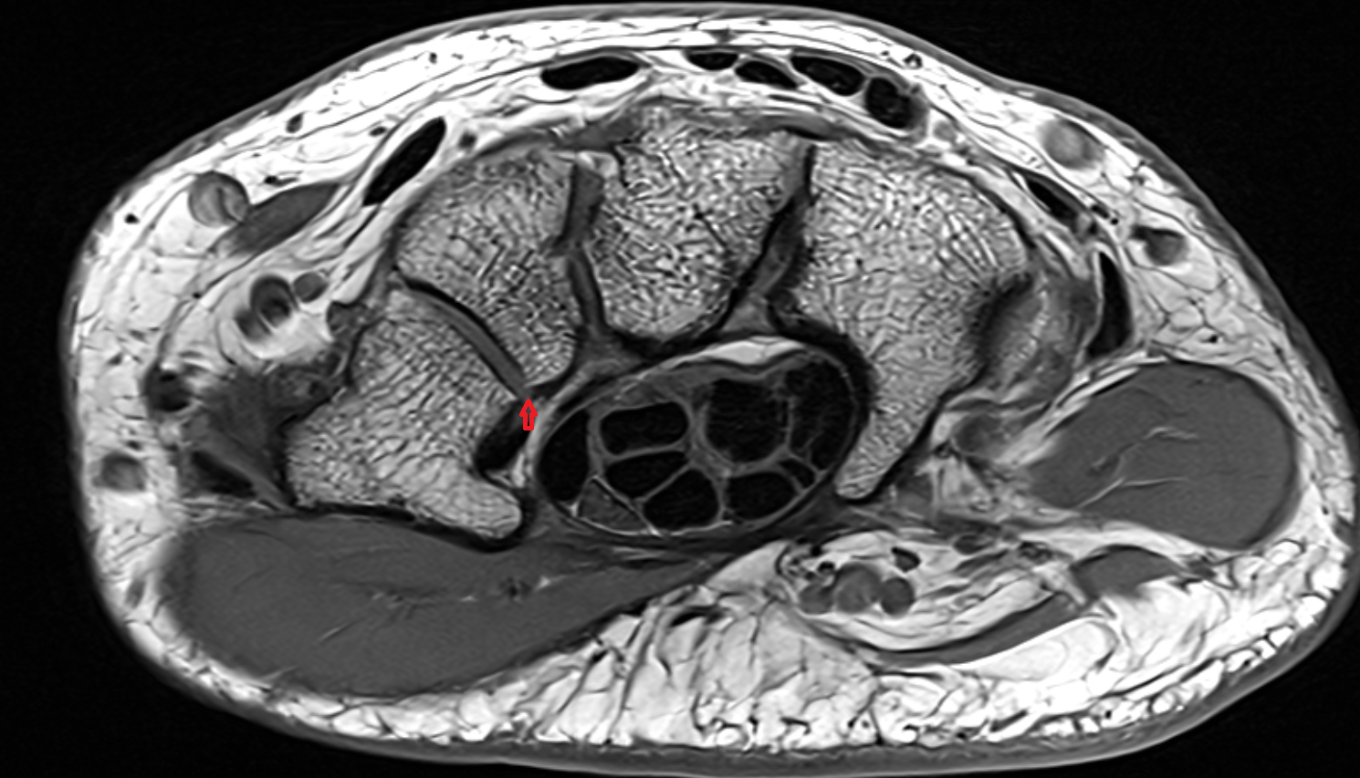 Palmar trapeziotrapezoid ligament  axial cross sectional anatomy 3T MRI AI enhanced radiology image-img-00000-00000