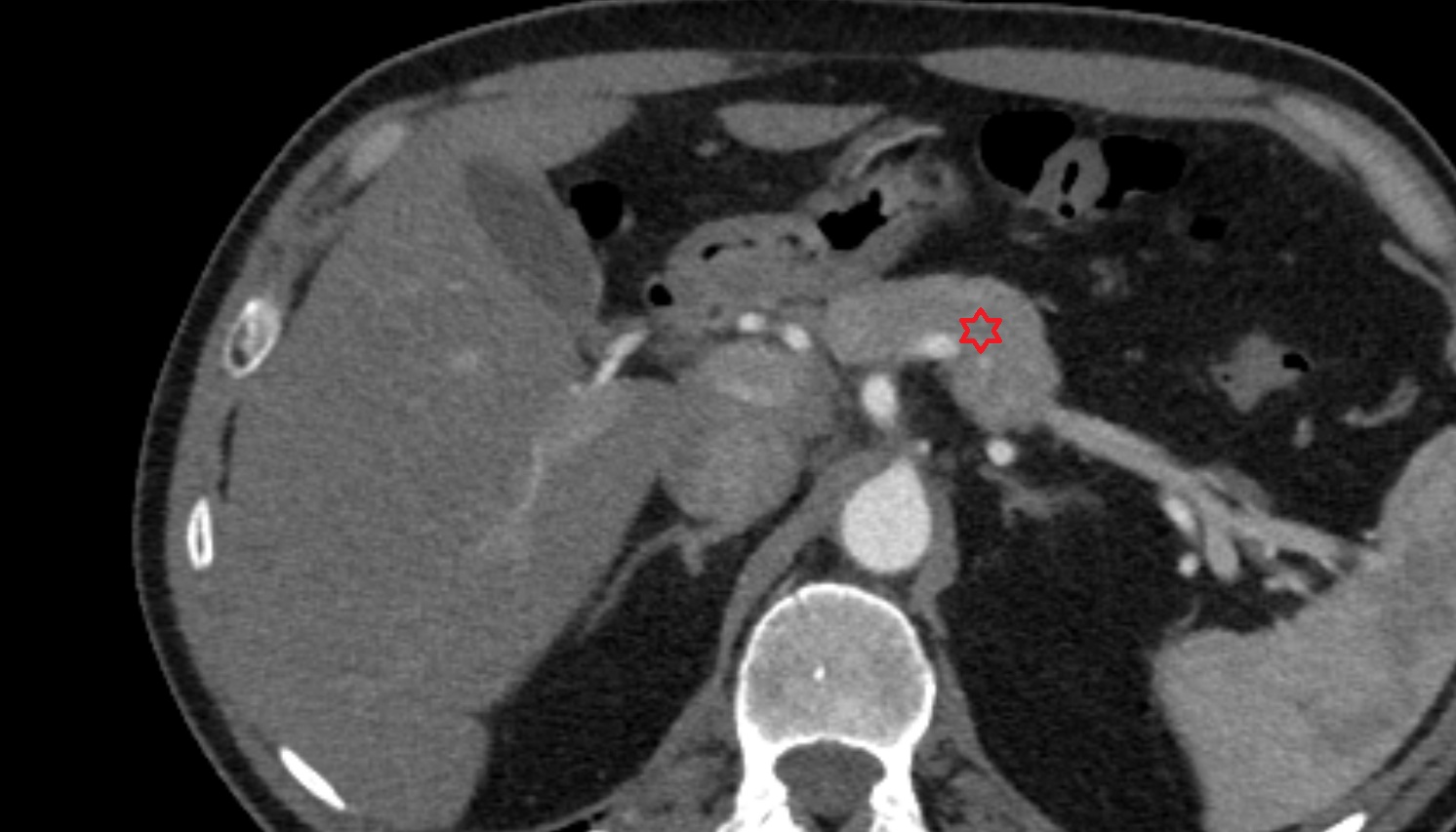 Pancreas  anatomy CT axial  image -img-00000-00000