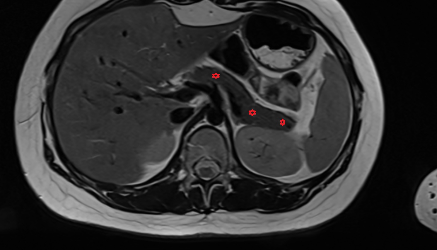 Pancreas  anatomy MRI axial  image -img-00000-00000