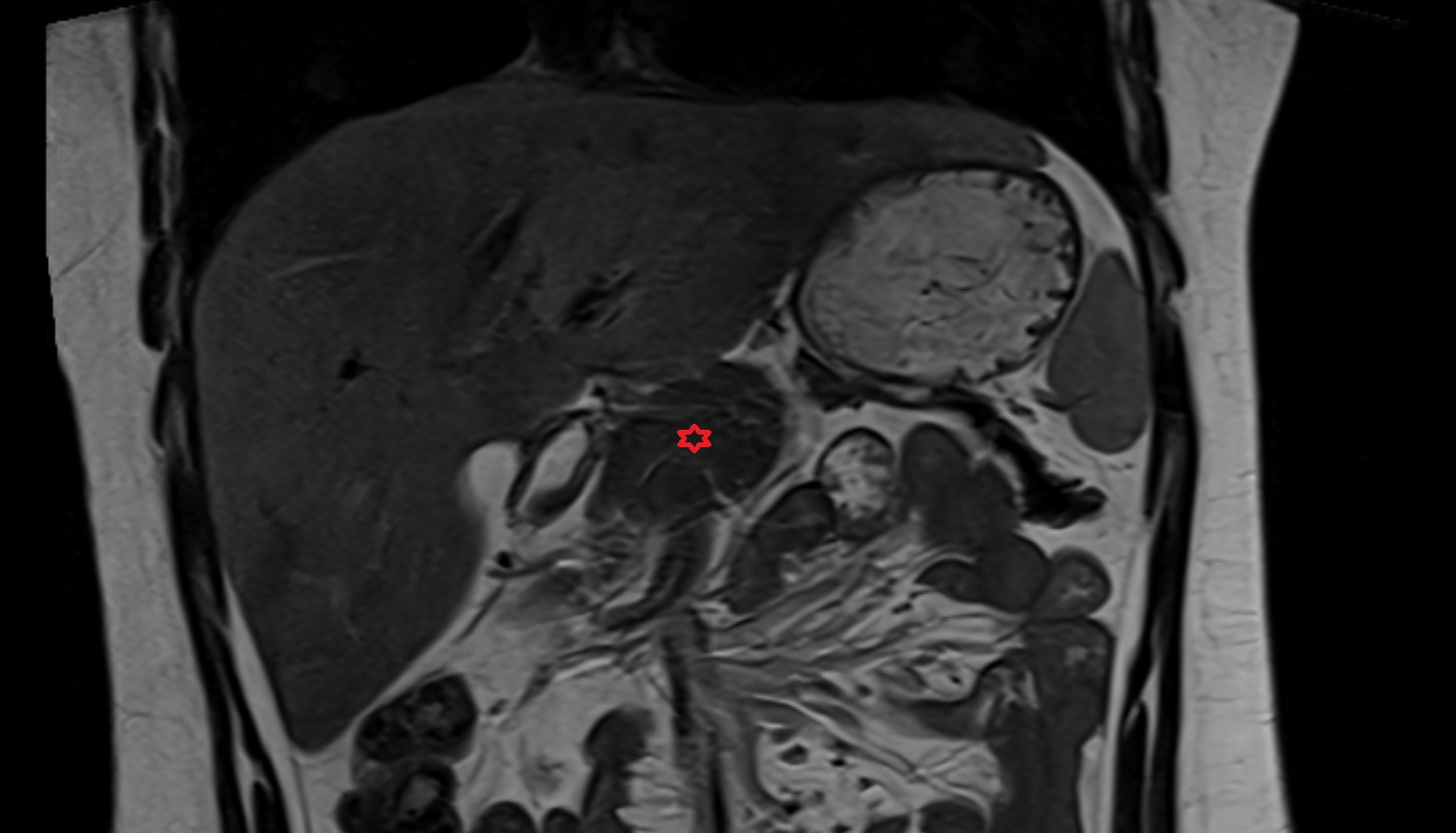 Pancreas  anatomy MRI coronal  image -img-00000-00000