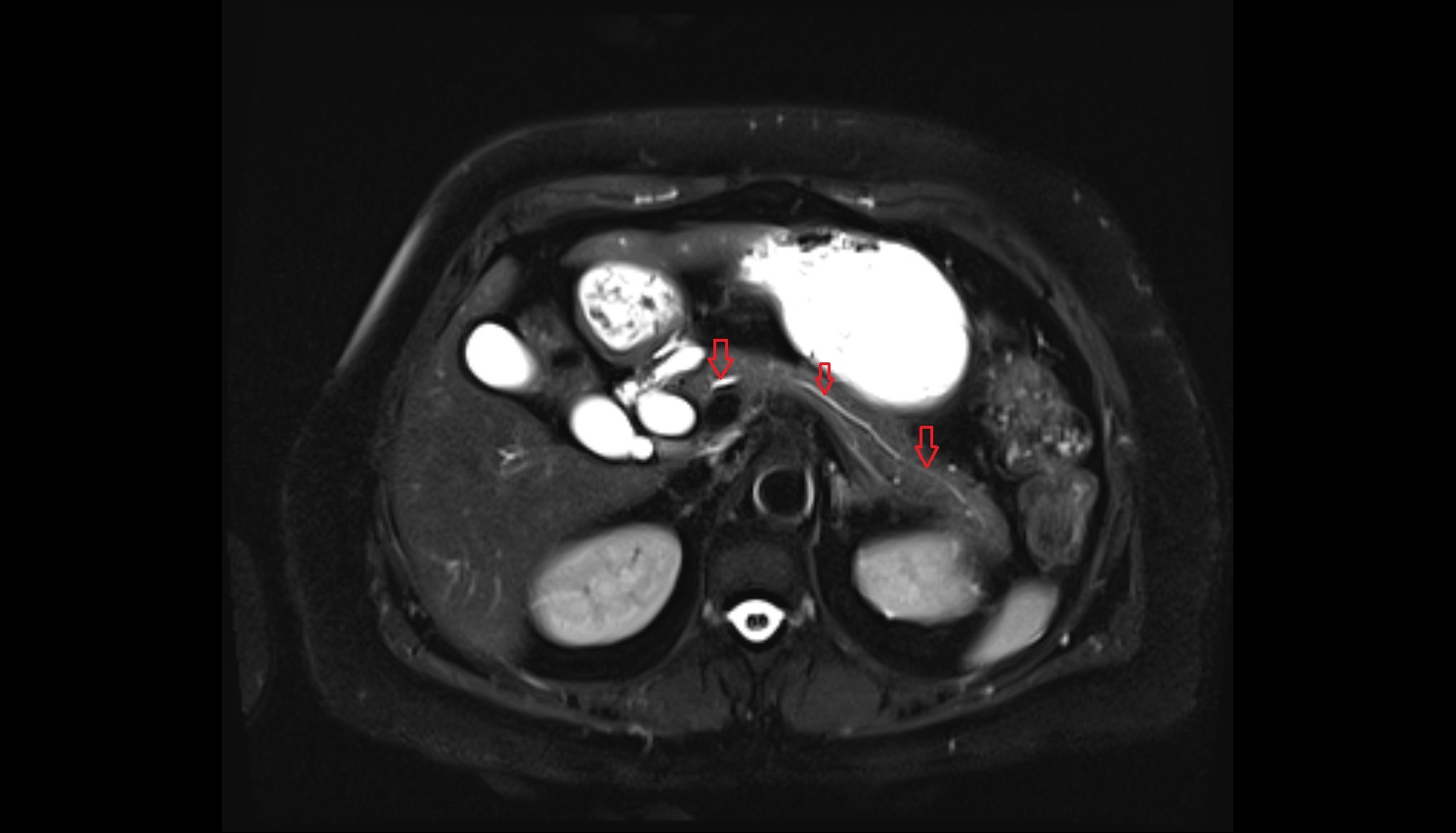 Pancreatic duct MRI axial anatomy image-img-00000-00000