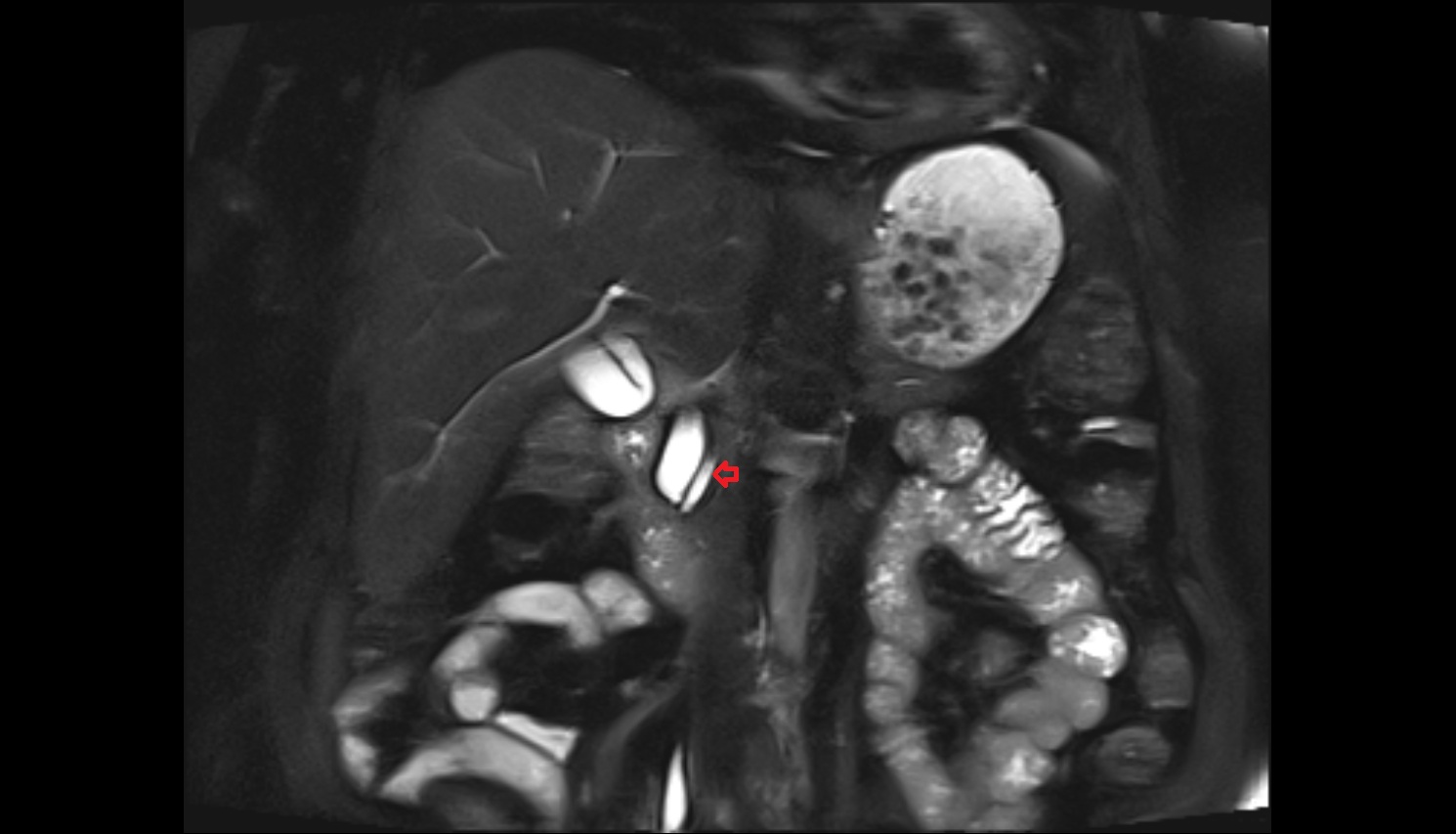 Pancreatic duct MRI coronal  anatomy image-img-00000-00000