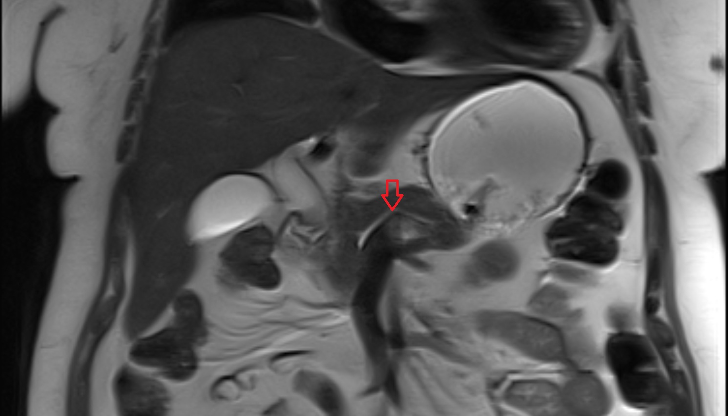 Pancreatic duct MRI coronal  anatomy image-img-00000-00000_00001