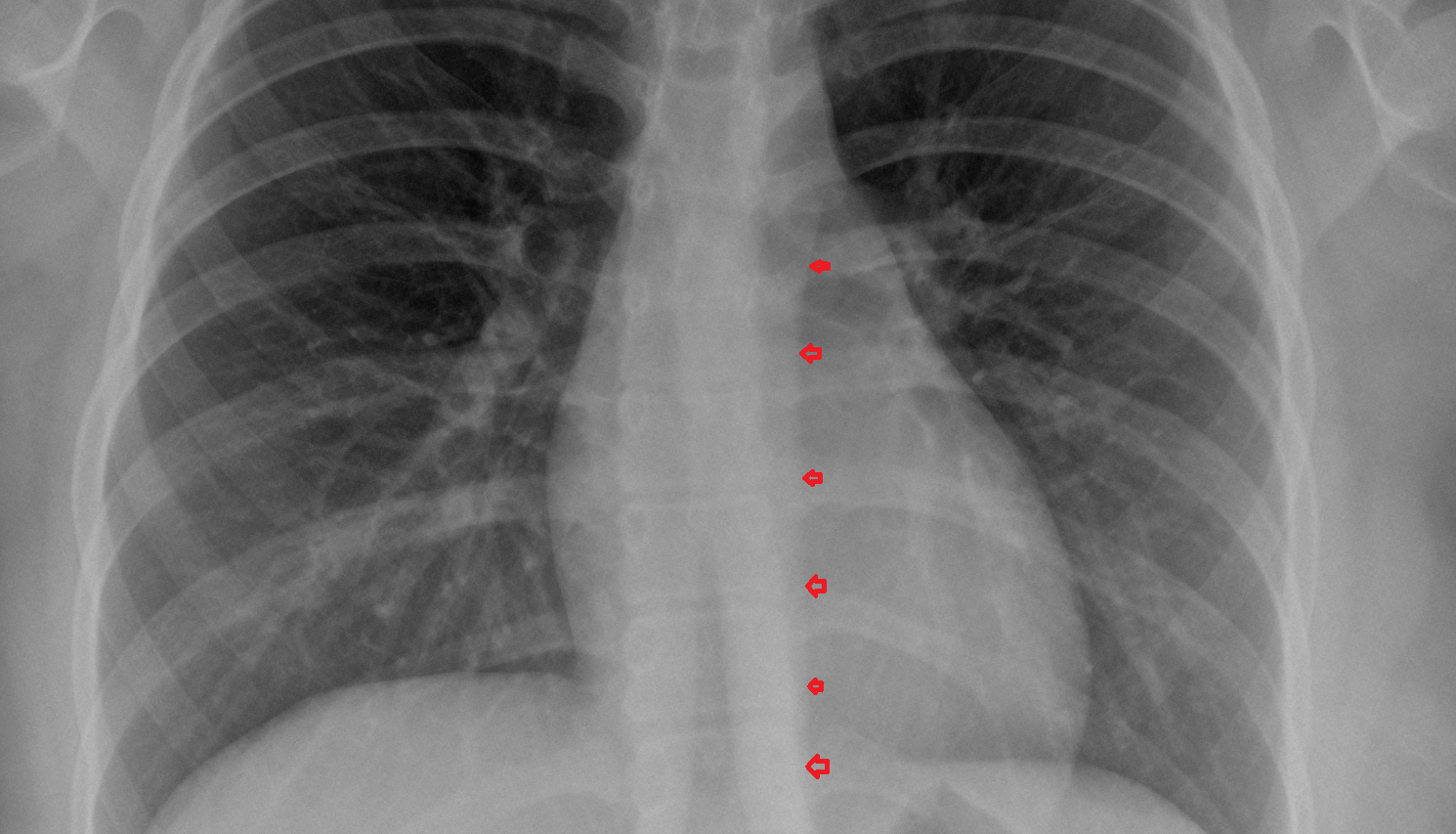 Paraaortic line x ray  Anatomy, Location and Imaging Appearance CT anatomy image -img-00000-00000