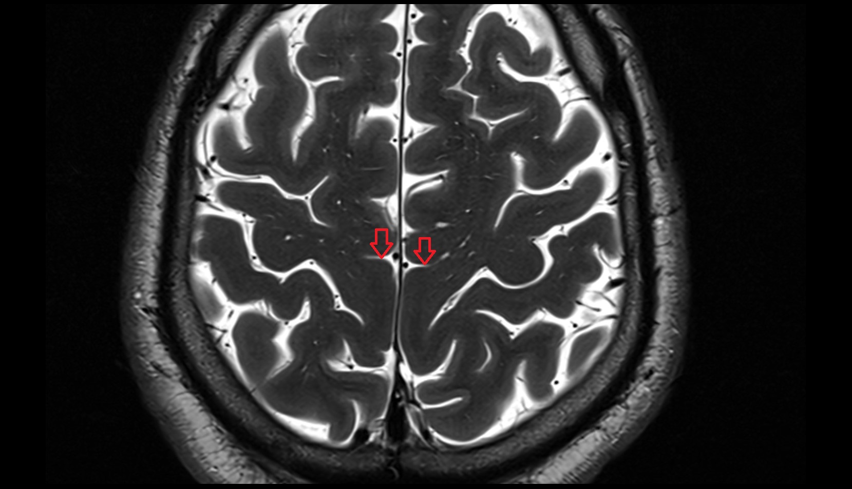 Paracentral sulcus MRI 3T axial image